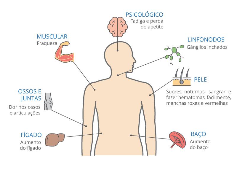 Leucemia pode ser causada por radiação ionizante e tabagismo