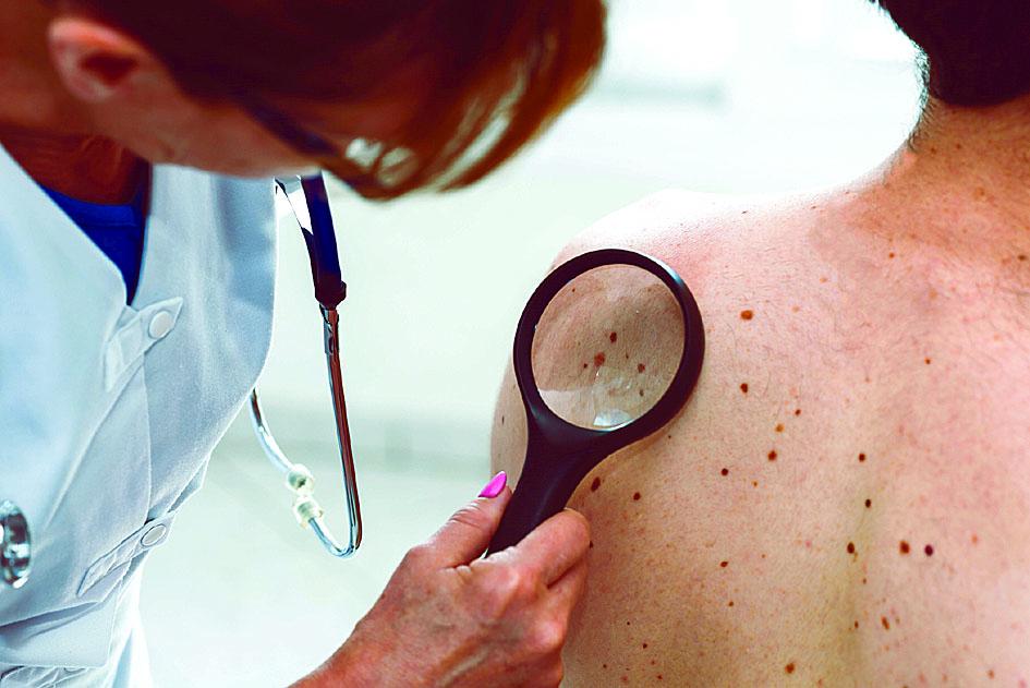 Câncer de pele é considerado o mais frequente no País