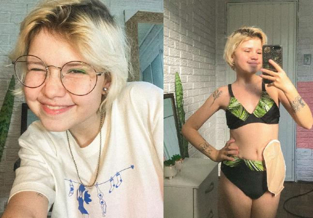 Influenciadora digital compartilha a rotina de viver com a Doença de Crohn