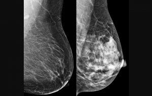 Ancestralidade é indicadora de risco para câncer de mama, mostra estudo de SP