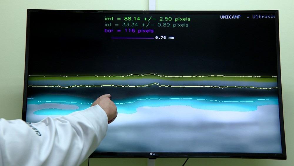 Pesquisadores da Unicamp criam exame mais eficaz para evitar infartos