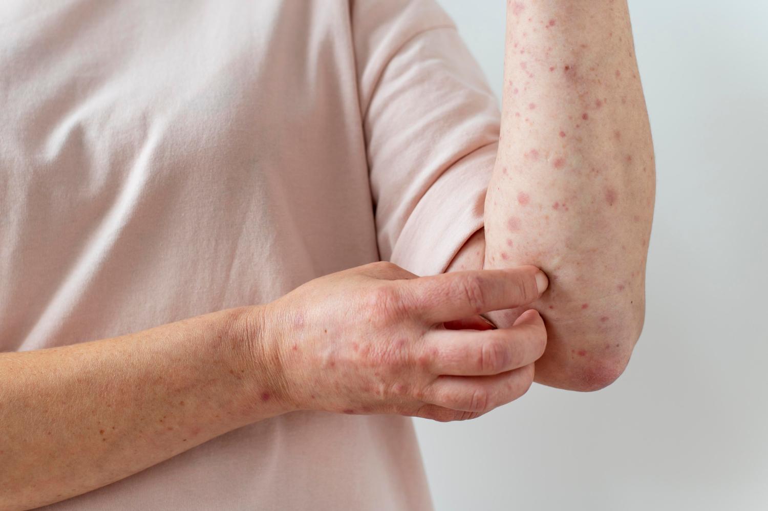 Itatiba não registra casos de mpox em 2026 e mantém monitoramento permanente da doença