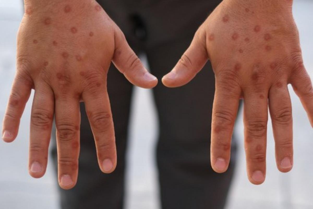 Jundiaí confirma primeiro caso de mpox em 2026 e reforça orientações de prevenção