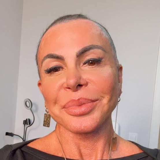 Gretchen mostra recuperação após transplante capilar: 'Olha como estou bem'