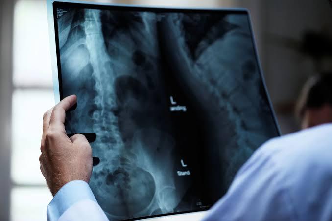 Osteoporose atinge homens e mulheres de maneira diferente